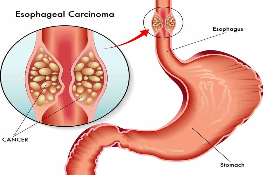 Carcinoma Esophagus (CA Esophagus)